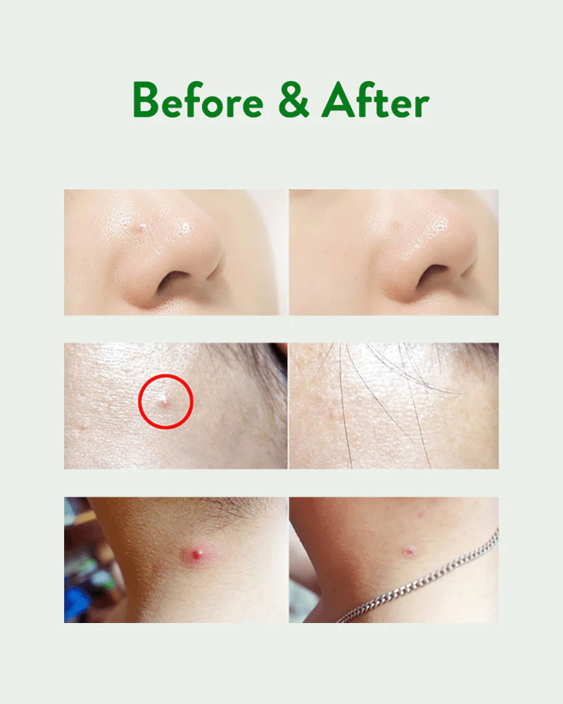 ACROPASS Trouble Cure (6 Skin Cleanser 6 Microdart Patches) - Image 7